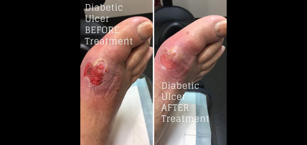 ulcer-before-1024x484-1 (2)