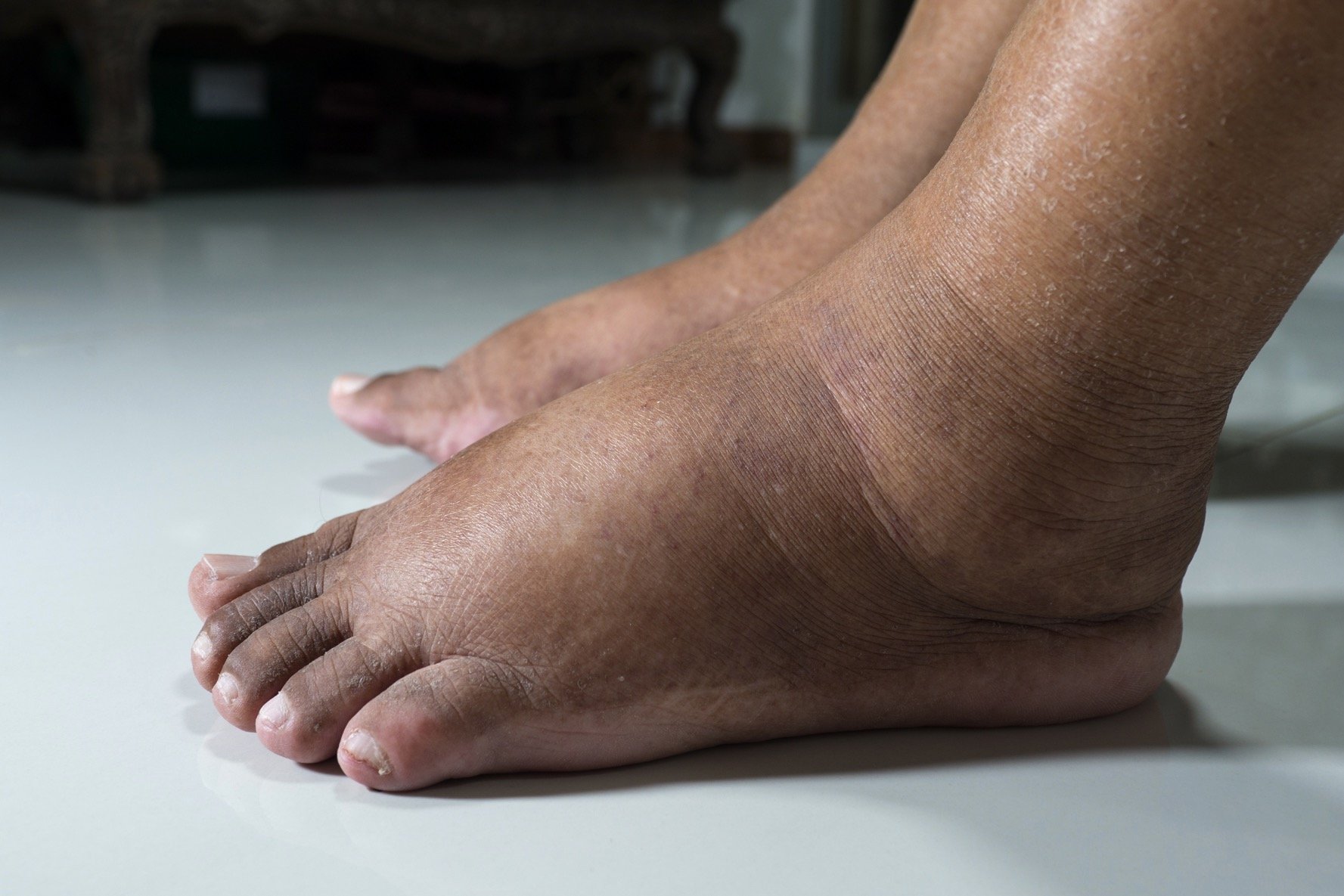 diabetes-mellitus_afd-common-foot-problem