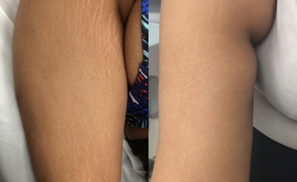 BeforeAfter_Skin_Stretch_June24-980x600-1
